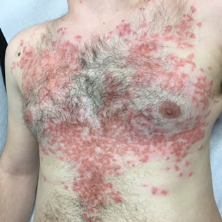 Come Curare Le Punture Di Cimici Da Letto