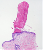 Multiple minute digitate hyperkeratosis