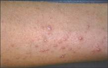 Multiple minute digitate hyperkeratosis