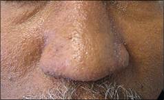 Multiple minute digitate hyperkeratosis