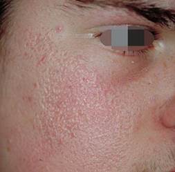 follicular hyperkeratosis face