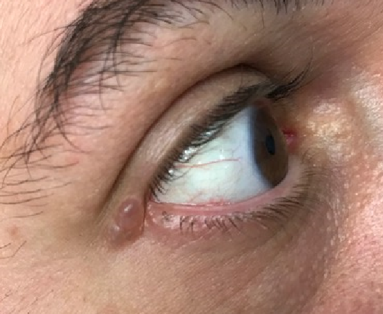 Idrocistoma Eccrino Idrocistoma Eccrino