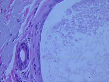 Idrocistoma Eccrino Idrocistoma Eccrino