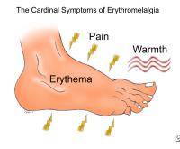 Erythromelalgia