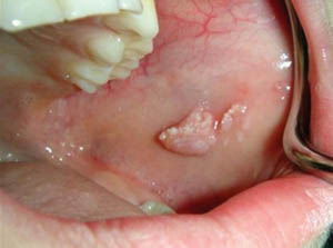 Focal epithelial hyperplasia