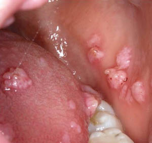 Focal epithelial hyperplasia Focal epithelial hyperplasia