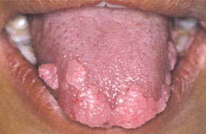 Focal epithelial hyperplasia