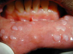 Focal epithelial hyperplasia Focal epithelial hyperplasia