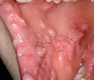 Focal epithelial hyperplasia