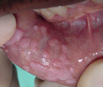 Focal epithelial hyperplasia Focal epithelial hyperplasia