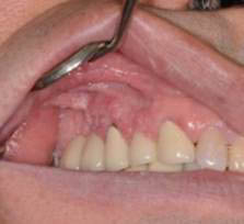Focal epithelial hyperplasia Focal epithelial hyperplasia