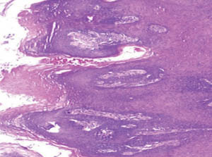 Focal epithelial hyperplasia Focal epithelial hyperplasia