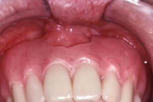 Focal epithelial hyperplasia Focal epithelial hyperplasia