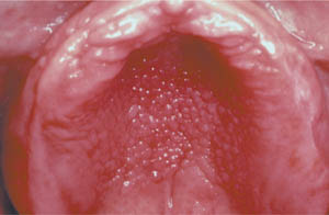 Focal epithelial hyperplasia Focal epithelial hyperplasia