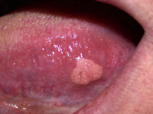 Focal epithelial hyperplasia Focal epithelial hyperplasia
