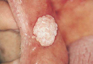 Focal epithelial hyperplasia Focal epithelial hyperplasia