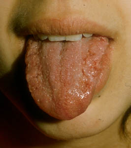 Focal epithelial hyperplasia Focal epithelial hyperplasia