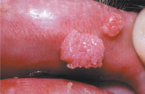 Focal epithelial hyperplasia Focal epithelial hyperplasia