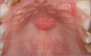 Focal epithelial hyperplasia Focal epithelial hyperplasia