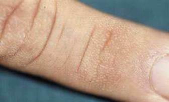 Huntley’s papules