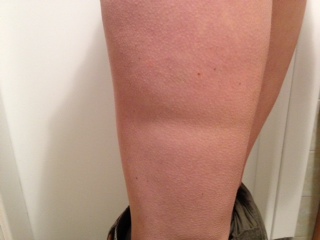 Related image of Indent In Thigh.
