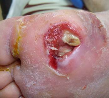 Infezioni del piede