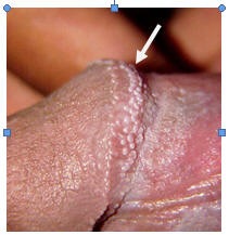 Pearly Penile Papules