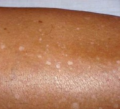 Postinflammatory hyperpigmentation | DermNet New Zealand