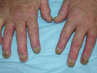 artrite psoriasica