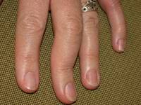 artrite psoriasica