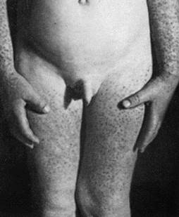 Sindrome_Gianotti_Crosti Sindrome_Gianotti_Crosti