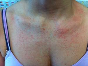Eruptive syringoma