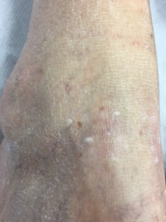 Image of Sebaceous hyperplasia Sebaceous hyperplasia