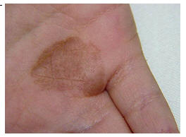 Tinea nigra