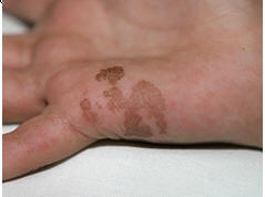 What is tinea nigra palmaris? Toll-free link at our bio.