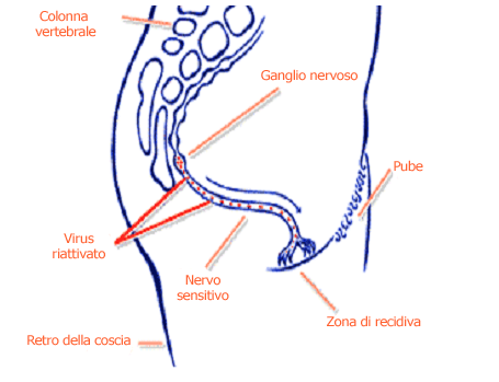 Herpes Genitale primario