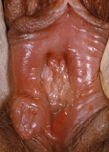 Sifiloma della vulva